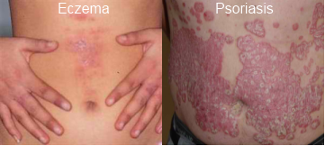 psoriasis and eczema together)