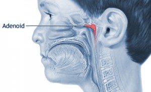 Adenoids-in-Children