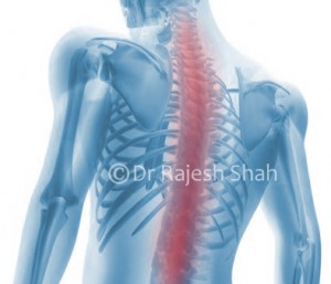 Ankylosing-Spondylitis