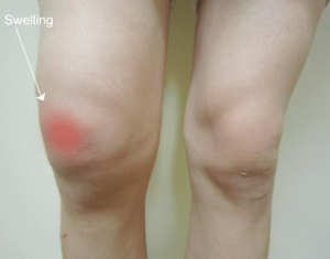 Arthritis-Knee-Pain