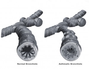 Asthmatic-Bronchitis-Treatment