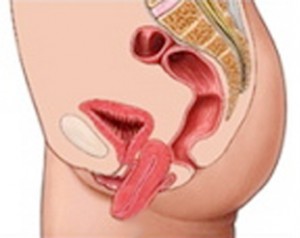 Bladder-Prolapse