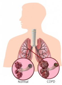 COPD-treatment