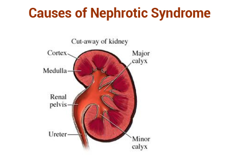Causes of Nephrotic Syndrome