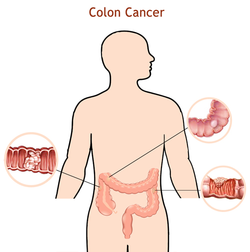 Colon-cancer-treatment