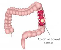 Colon-or-bowel-cancer