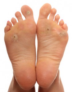 corn under foot hurts