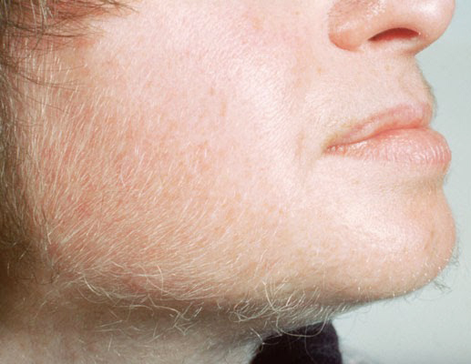 Facial Hair Growth In Woman 108