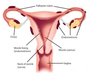 Endometriosis