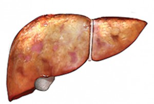 Fatty-Liver