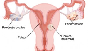 Frozen Pelvis Treatment
