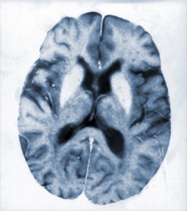 hallervorden spatz disease