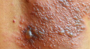 Herpes