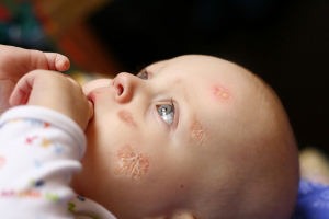 Impetigo-and-homeopathic-treatment