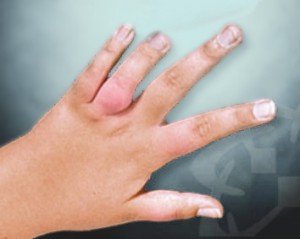Juvenile-arthritis