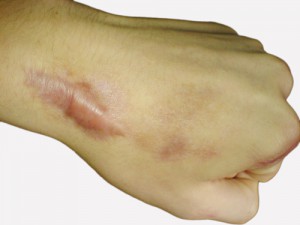 Keloid