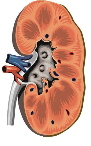 Homeopathic Medicines for Kidney stones