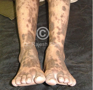Lichen-Planus2