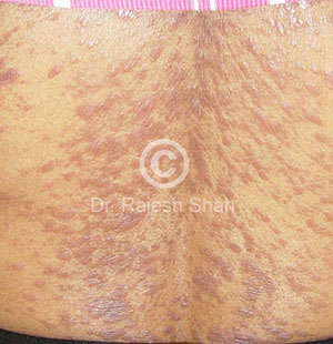 Lichen planus on back