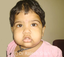 Nephrotic Syndrome treatment in Children