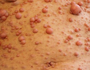 Neurofibromas
