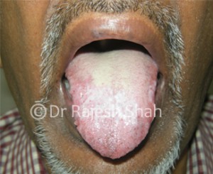 Oral-Lichen-Planus