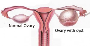 Ovary-with-cyst