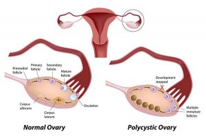 PCOS