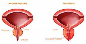 Prostatitis-Complications