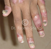 Management of Psoriasis with Psoriatic Arthritis