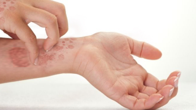 Psoriasis