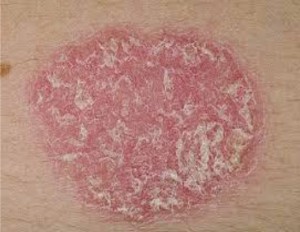 Psoriasis
