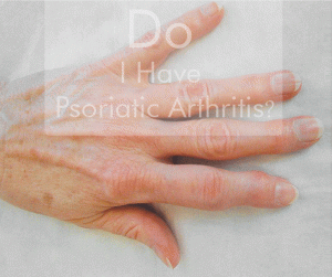 Psoriatic-Arthritis