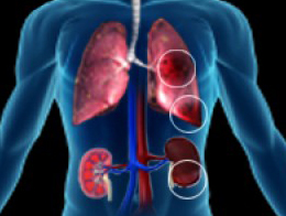 Pulmonary_Renal_Syndrome
