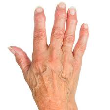 Rheumatoid Arthritis