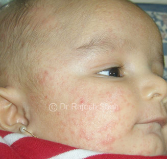 Symptoms of Eczema