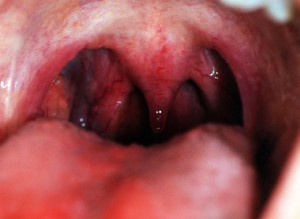 Tonsils
