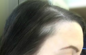 Traction-Alopecia