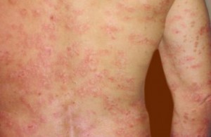 Treatment-for-Guttate-Psoriasis