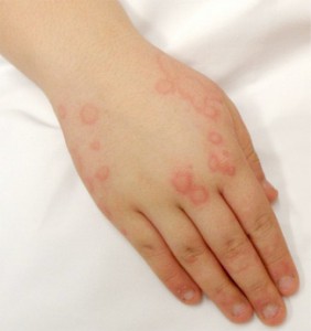 Urticaria-treatment