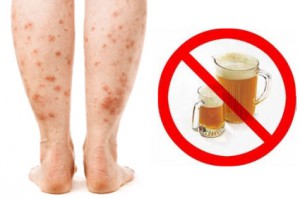 WHY-IS-ALCOHOL-BAD-FOR-PSORIASIS