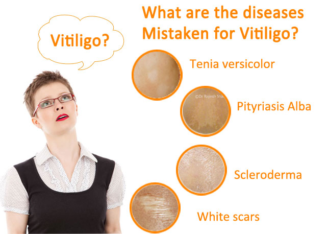 Diseases mistaken for Vitiligo