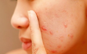 acne-rosacea