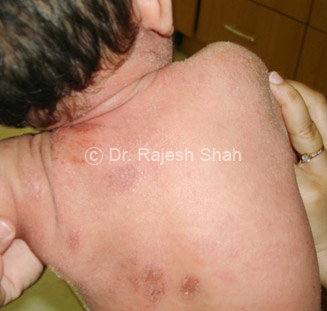 What_is_Eczema