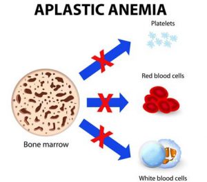 causes-of-aplastic-anemia-and-mds