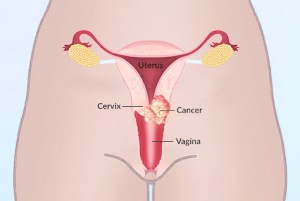 cervical-cancer