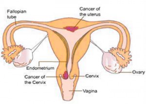 cervical-cancer