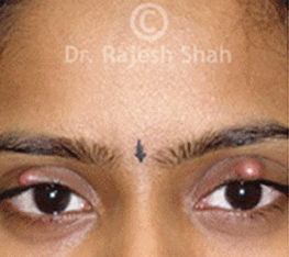 chalazion_case_photo
