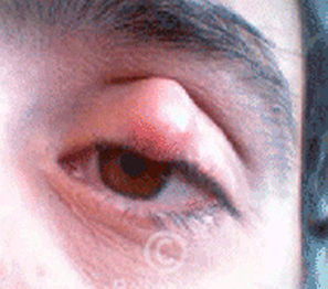 Chalazion-Treatment-photo