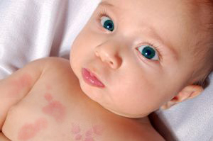Chronic hives in children
